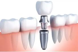 Image result for dental implant