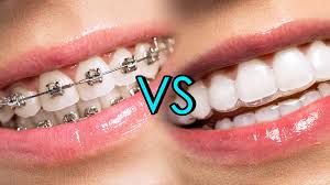 Braces work by exerting pressure on your jawline to change the way your smile appears. Metallic Braces Vs Invisalign Braces Whats Best Regent Dental Uk