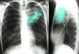 The interpretation of a chest film requires the understanding of basic principles. Radiography Amboss