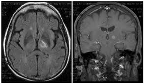 Image result for Thalamotomy