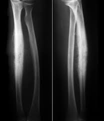 Ewing is a family medicine doctor in richmond, virginia. Image Ewing Sarcoma Of The Radius Msd Manual Professional Edition