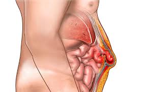 Image result for stomach hernia symptoms