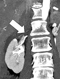 The Renal Vasculature: What the Radiologist Needs to KnowRadioGraphics
