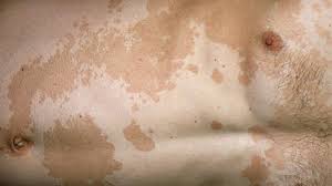 Image result for Postinflammatory Hypopigmentation