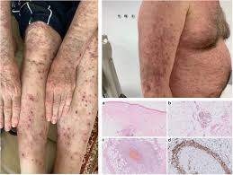 Purpura is not a disease per se but is indicative of an underlying cause of bleeding. Skin Changes In Hairy Cell Leukemia Springerlink
