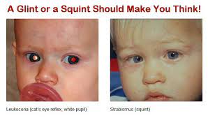 Common symptoms of eye cancer. Signs And Symptoms Of Retinoblastoma We C Hope