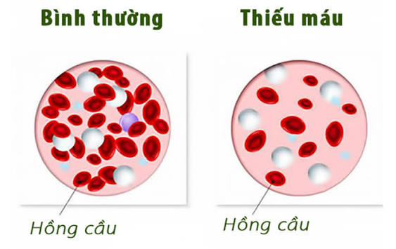Thiếu máu: Nguyên nhân, triệu chứng, chẩn đoán và điều trị
