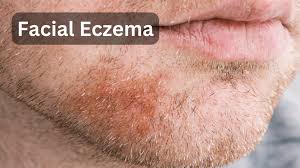 Image result for ekzema face