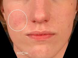 Anyone can get lupus, but women are more likely to get. Lupus Erythematodes Chronicus Discoides Altmeyers Encyclopedia Department Dermatology