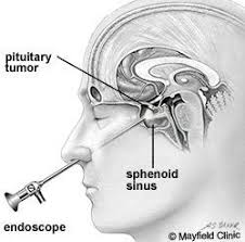 A Pituitary Gland Tumor Is Removed Via Endoscopic Transsphenoidal Surgery This Is A Surgery Performed Thro Pituitary Gland Tumor Pituitary Gland Sinus Disease