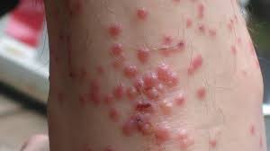 How Do You Treat Turkey Mite Bites