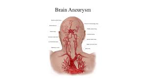 An intracranial aneurysm, also known as a brain aneurysm, is a cerebrovascular disorder in which weakness in the wall of a cerebral artery or vein causes a localized dilation or ballooning of the blood. Brain Aneurysm College Of Art And Design Rit