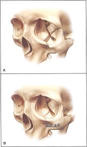 Maybe you would like to learn more about one of these? Orbital Deformity After Craniofacial Fracture Repair Avoidance And Treatment World Renowned Bespoke Cosmetic Plastic Surgeon Boston Dr Michael Yaremchuk