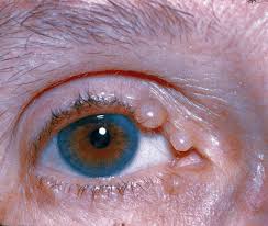 According to the american cancer society, just over 100,000 new cases of skin cancer are diagnosed in the united states each year. Lesson Don T Be Stumped By These Lumps And Bumps