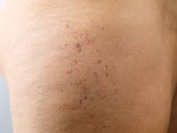 Image result for liver spots on legs
