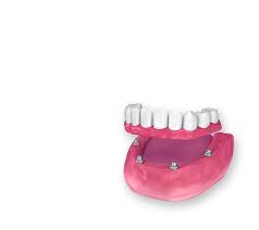 Maybe you would like to learn more about one of these? All On 4 Dental Implants Orlando Fl Koyfman Dental