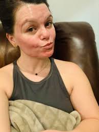 How to choose the right AHA-BHA peel for my skin type?