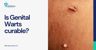 Image result for genital warts