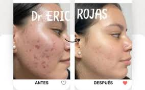 Mejora la sudoración de las axilas.