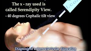 Image result for SC Dislocation