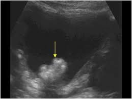 Bladder cancer, like any other type, is easier to treat when it's caught early. 2 2 1 Bladder Tumors Ultrasound Cases