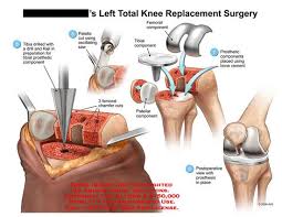 Astepaway New Search Experience Knee Surgery Knee Replacement Surgery Video Surgery