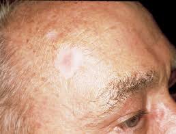 This skin cancer often develops on the head or neck and looks like a shiny, raised, and round growth. Basal Cell Carcinoma The Skin Cancer Foundation