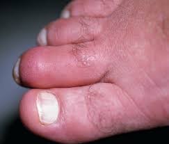 Maybe you would like to learn more about one of these? Why Is This Man S Toe Painful Swollen And Red Rheumatology