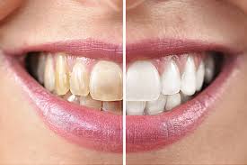 I have natural dark hair and on my ends is a few tones lighter from a previous bleaching that i did 2 years ago. Was Kostet Bleaching Zahnaufhellung In Stuttgart