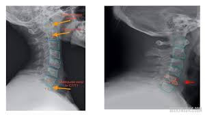 Please understand that our phone lines must be clear for urg. Cervical Spine X Ray Interpretation Osce Guide Geeky Medics