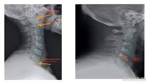 This procedure may be used to diagnose back or neck pain, fractures or broken bones, arthritis, degeneration of the disks, tumors, or other problems. Cervical Spine X Ray Interpretation Osce Guide Geeky Medics