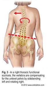 Scoliosis Spinal Compensation Scoliosis Exercises Massage Therapy Scoliosis