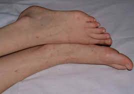 Thrombocytopenia, which is a deficiency in blood platelets, can cause bleeding and bruising in the dermis. Petechial Rash