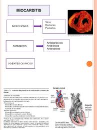 Miocarditis by medicinaudm 11544 views. Miocarditis Inflamacion Virus