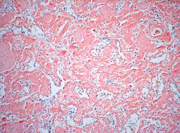 Colours, namely green and yellow, were reported under these conditions in 1945, although these are only two of various anomalous. Biogenex Special Stain Amyloid Congo Red In Liver 20x Amyloid Is An Abnormal Fibril Like Protein That Deposits Extracellularly In Va Red Stain Stain Red