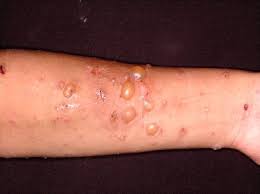 Bullous Pemphigoid In A Chronic Renal Allograft Rejection Patient A Case Report And Review Of The Literature Sciencedirect