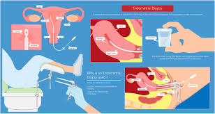 Large fibroids can put pressure on the bladder or rectum, leading to impaired urination, problems with stool. What Is An Endometrial Biopsy Untitled