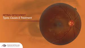 Most retinal breaks, holes, or tears are not a result of injury. Retinal Detachment Types Causes Treatment Prasad Netralaya