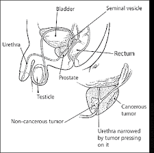 High psa levels are suggestive of prostate cancer onset, the public has long been told. Early Prostate Cancer What You Should Know American Family Physician