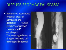 Slideshare Barium Swallow Presentation Cd943a6f Resumesample Resumefor Esophageal Spasm Medical Sites Symptoms