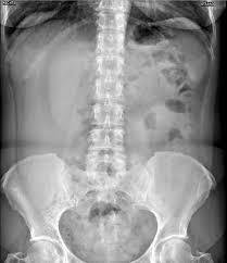 Enlarged Liver Riedel Lobe Radiology Case Radiopaedia Org Enlarged Liver Radiology Lobes
