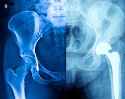 Image result for Hip XRay
