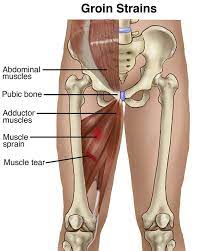 Groin pain might be worsened by continued use of the injured area. Physical Therapy Guide To Groin Strain Choosept Com