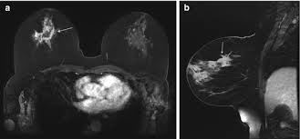 You can have breast cancer without feeling anything out of the ordinary. Mri Appearance Of Invasive Breast Cancer Oncohema Key