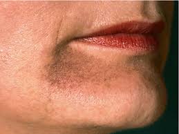 20 naegeli syndrome belongs to a group of disorders known as ectodermal dysplasias. Spontaneous Fading Of Reticular Pigmentation In Naegeli Franceschetti Jadassohn Syndrome Semantic Scholar
