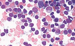 Image result for Leukemia