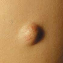 Nodulo Lesion De Contenido Solido Lesion Primaria Hair Beauty Beauty Hair