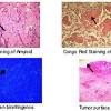 It is positive with congo red, a stain easy to make and relatively specific; Https Encrypted Tbn0 Gstatic Com Images Q Tbn And9gcq9dxg 0mip6ittwn9eb Xkjb1lsnqh58ffoypwfn0zstumcxo Usqp Cau