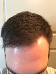 A process of shampooing hair carefully with beer will be able to solve all the problems of brewing technology comes from the west, which tells us that western women probably discover the detection of using beer for hair growth and smoothness. Hair Restoration Amy Brenner Md Associates