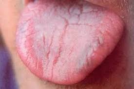 Fissures Dans La Langue De L Enfant Causes Traitement Avec Competence Sur La Sante Sur Ilive